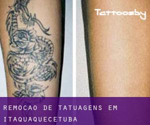 Remoção de tatuagens em Itaquaquecetuba