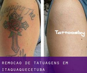 Remoção de tatuagens em Itaquaquecetuba
