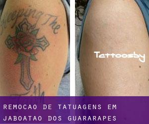 Remoção de tatuagens em Jaboatão dos Guararapes