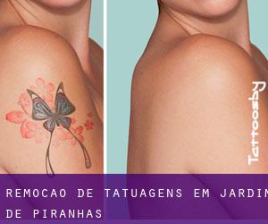 Remoção de tatuagens em Jardim de Piranhas