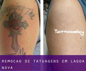 Remoção de tatuagens em Lagoa Nova