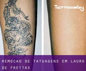 Remoção de tatuagens em Lauro de Freitas