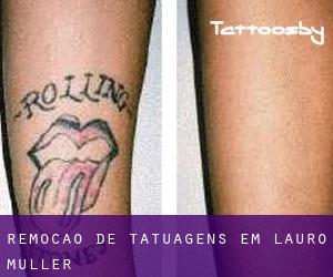 Remoção de tatuagens em Lauro Muller