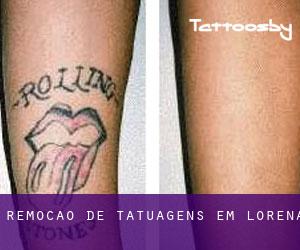 Remoção de tatuagens em Lorena