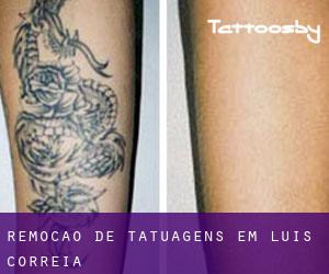Remoção de tatuagens em Luís Correia
