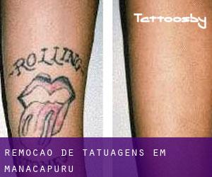 Remoção de tatuagens em Manacapuru