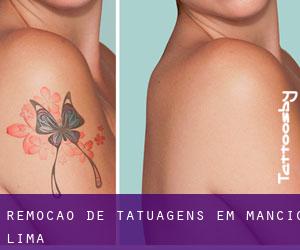 Remoção de tatuagens em Mâncio Lima
