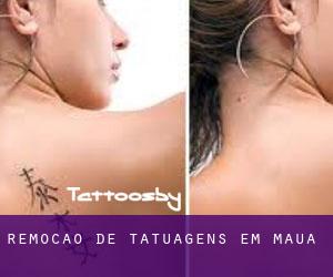 Remoção de tatuagens em Mauá