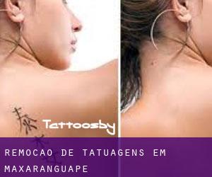 Remoção de tatuagens em Maxaranguape
