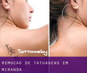 Remoção de tatuagens em Miranda