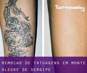 Remoção de tatuagens em Monte Alegre de Sergipe