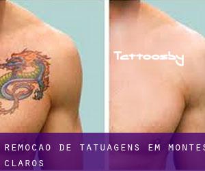Remoção de tatuagens em Montes Claros