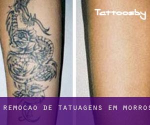 Remoção de tatuagens em Morros