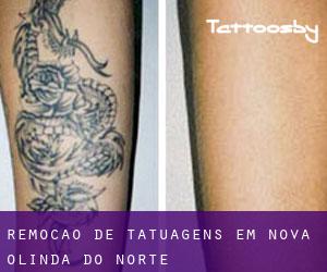 Remoção de tatuagens em Nova Olinda do Norte