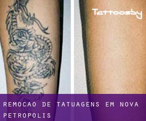 Remoção de tatuagens em Nova Petrópolis