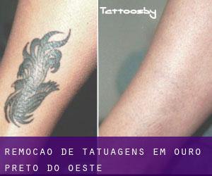 Remoção de tatuagens em Ouro Preto do Oeste