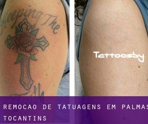Remoção de tatuagens em Palmas (Tocantins)