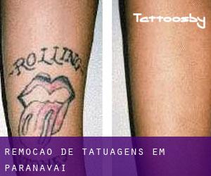 Remoção de tatuagens em Paranavaí
