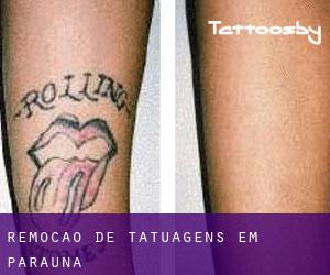 Remoção de tatuagens em Paraúna