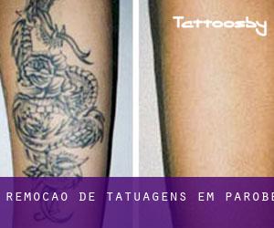 Remoção de tatuagens em Parobé