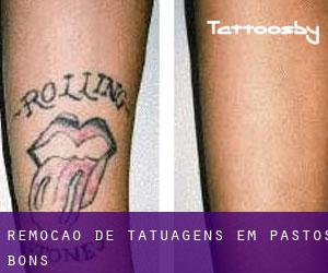 Remoção de tatuagens em Pastos Bons