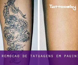 Remoção de tatuagens em Pauini