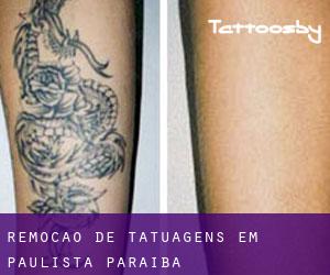 Remoção de tatuagens em Paulista (Paraíba)