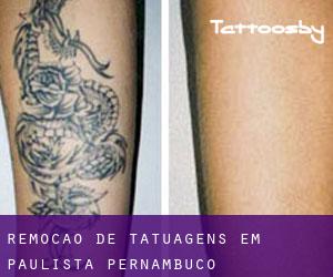 Remoção de tatuagens em Paulista (Pernambuco)