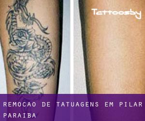 Remoção de tatuagens em Pilar (Paraíba)