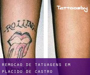 Remoção de tatuagens em Plácido de Castro