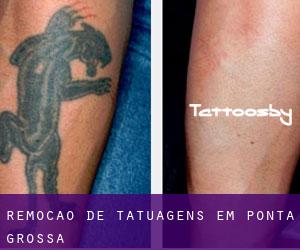 Remoção de tatuagens em Ponta Grossa