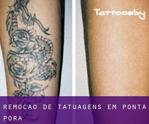 Remoção de tatuagens em Ponta Porã