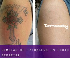 Remoção de tatuagens em Porto Ferreira