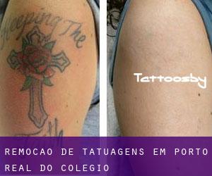 Remoção de tatuagens em Porto Real do Colégio