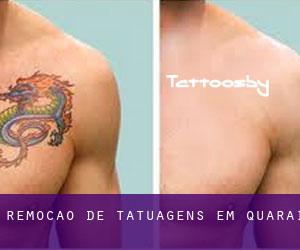 Remoção de tatuagens em Quaraí