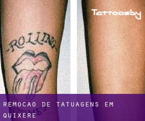 Remoção de tatuagens em Quixeré