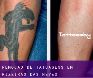 Remoção de tatuagens em Ribeirão das Neves