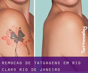 Remoção de tatuagens em Rio Claro (Rio de Janeiro)