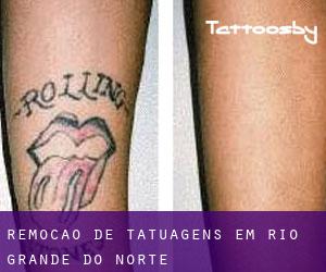 Remoção de tatuagens em Rio Grande do Norte