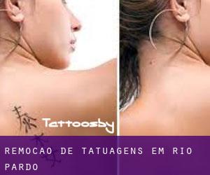 Remoção de tatuagens em Rio Pardo