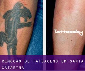 Remoção de tatuagens em Santa Catarina