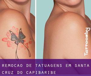 Remoção de tatuagens em Santa Cruz do Capibaribe