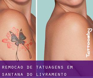 Remoção de tatuagens em Santana do Livramento