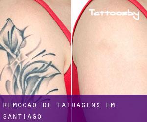 Remoção de tatuagens em Santiago