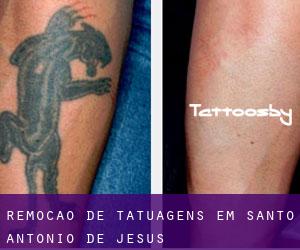 Remoção de tatuagens em Santo Antônio de Jesus