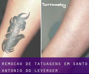 Remoção de tatuagens em Santo Antônio do Leverger