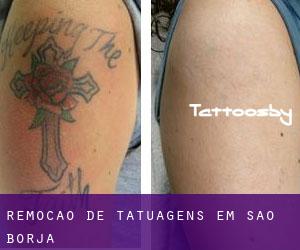 Remoção de tatuagens em São Borja