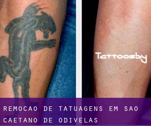 Remoção de tatuagens em São Caetano de Odivelas