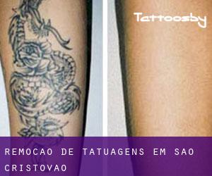 Remoção de tatuagens em São Cristóvão