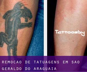 Remoção de tatuagens em São Geraldo do Araguaia